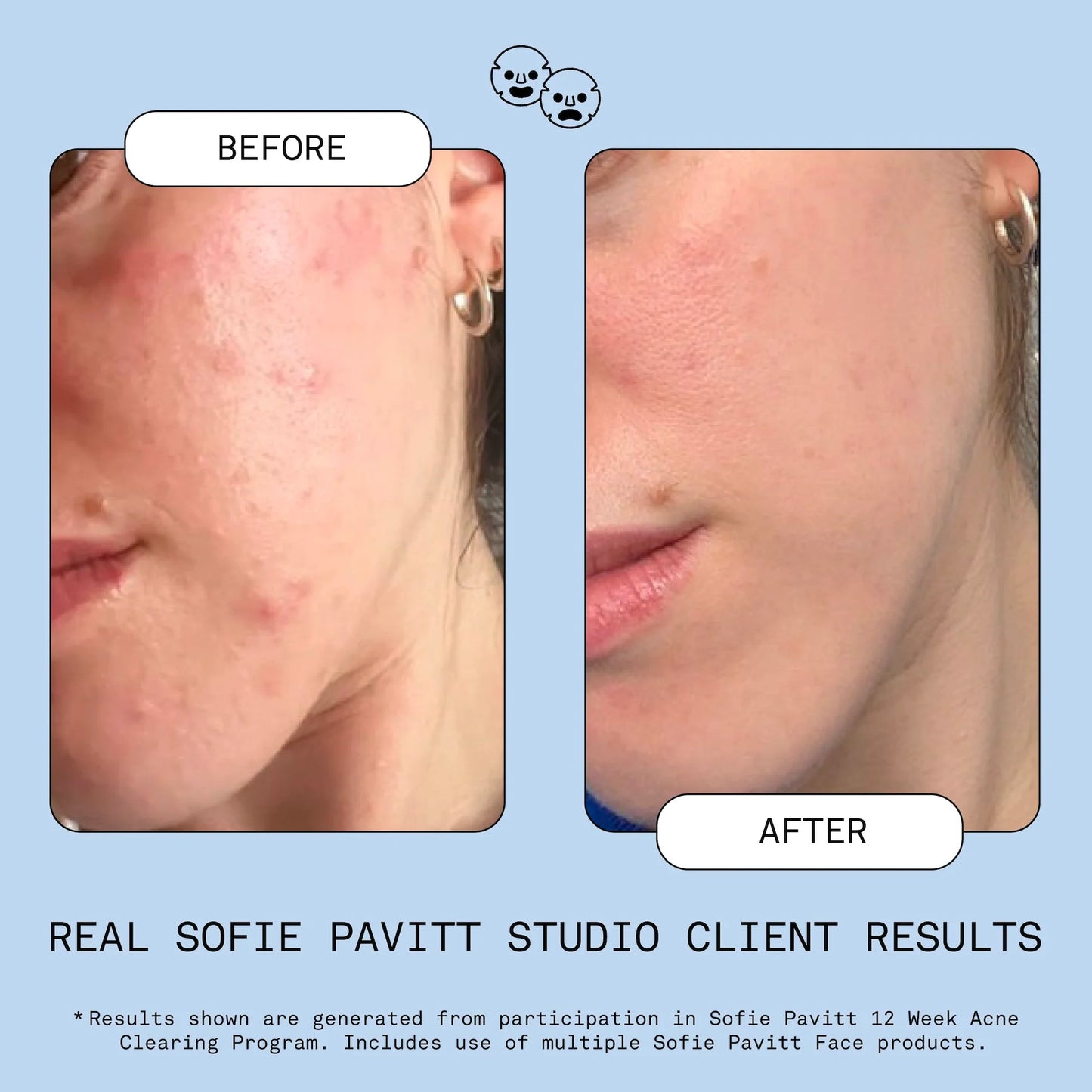 Sofie Pavitt Fridge to Face Blemish Defense Mist